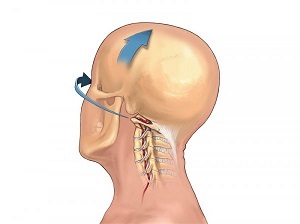 چگونه استئوکندروز ستون فقرات گردنی خود را نشان می دهد