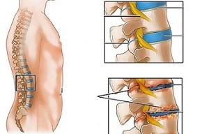 علل استئوکندروز ستون فقرات کمر