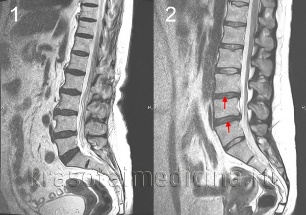 osteochondrosis ستون فقرات